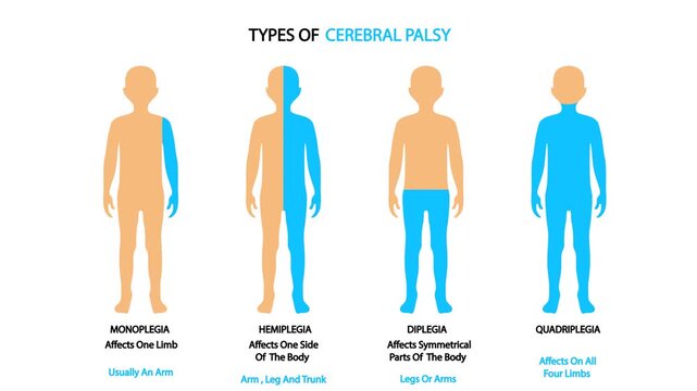 Medical vector animation displaying human body silhouettes illustrating limb paralysis patterns including monoplegia, hemiplegia, diplegia, and quadriplegia, highlighting cerebral palsy