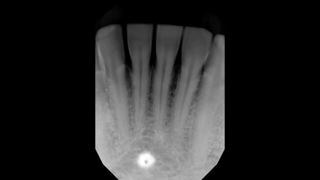 Close Up of a Dental X-ray Showcasing the Incisors and the Lingual Foramen