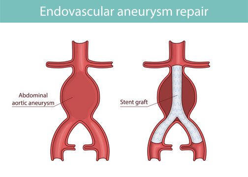 Illustration of aortic aneurysm after stent-graft intervention.
