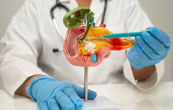 Pancreatitis, pancreatic cancer, Asian doctor with pancreas, gallbladder and bile duct human anatomy model at hospital.
