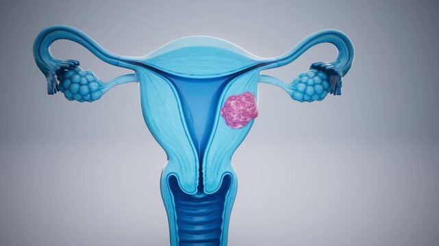 Conceptual 3D animation of a uterine fibroid and uterine anatomy