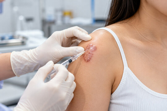 Keloid Scar Steroid Injection Treatment on Shoulder in Dermatology Clinic