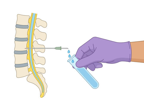 Lumbar Puncture Procedure Illustration: Medical Spinal Tap Diagram showing CSF Collection from the Spine into a Test Tube