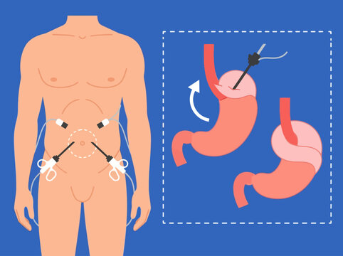 Medical Illustration of Laparoscopic Nissen Fundoplication Surgery for GERD Treatment and Hiatal Hernia Repair