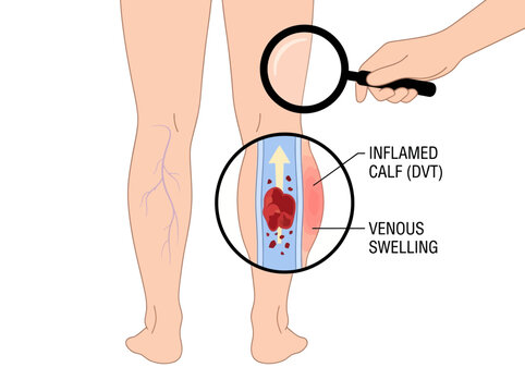 Deep Vein Thrombosis DVT Medical Illustration showing Blood Clot in Leg Vein with Calf Swelling and Varicose Veins