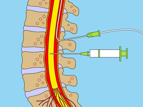 Medical Illustration of Spinal Tap and Epidural Anesthesia Procedures on the Human Spine
