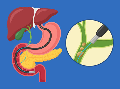 Medical Illustration of ERCP Procedure for Gallstone Removal from Bile Duct, Showing Liver, Pancreas, Stomach, and Endoscope Path