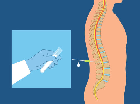 Lumbar Puncture and Spinal Tap Procedure Illustration Showing Cerebrospinal Fluid CSF Collection for Medical Diagnosis and Spinal Cord Anatomy