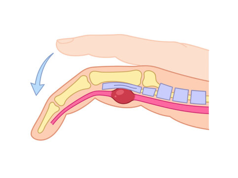 Trigger Finger Medical Illustration - Stenosing Tenosynovitis Anatomy of Flexor Tendon Nodule and Pulley System in Human Hand
