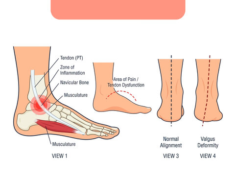 Posterior Tibial Tendon Dysfunction PTTD Anatomy Diagram Showing Foot Inflammation, Flat Feet Arch Collapse, and Valgus Ankle Deformity - Medical Vector Illustration