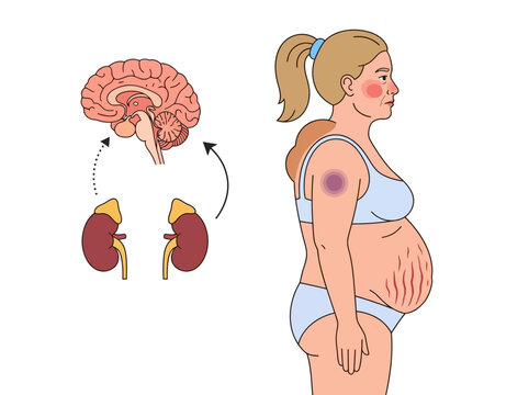 Cushing's Syndrome Medical Illustration with Symptoms and Hormonal Organ Diagram
