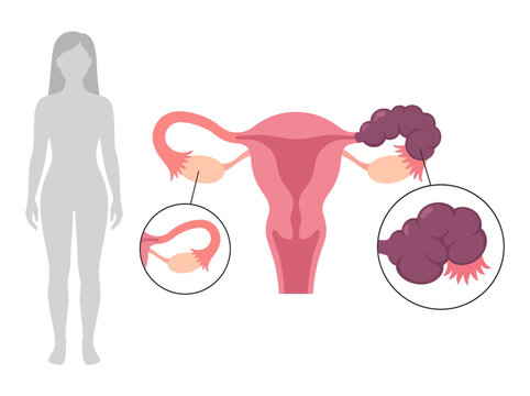 Medical Illustration of Salpingitis and Pelvic Inflammatory Disease PID in the Female Reproductive System