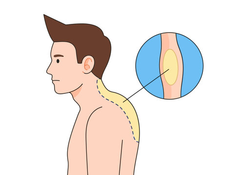 Medical Illustration of Buffalo Hump or Dowager's Hump on Man's Neck and Back with Fatty Tissue Detail - Posture and Spinal Health Concept