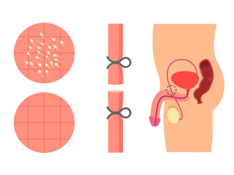 Medical Illustration of a Vasectomy Procedure showing Male Reproductive Anatomy, Sterilization Process, and Sperm Count Comparison for Birth Control Education