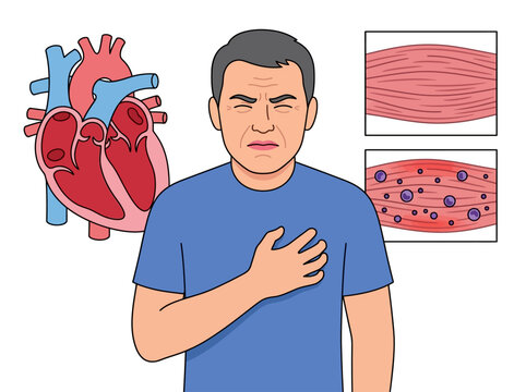 Medical Illustration of a Man Having a Heart Attack with Anatomical Heart and Muscle Tissue Detail