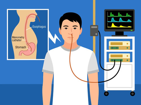 Medical Illustration of Esophageal Manometry Procedure Showing Catheter Insertion and Pressure Monitor for Digestive Health Diagnosis