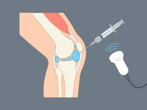 Ultrasound Guided Knee Joint Injection Medical Illustration for Arthritis and Pain Management
