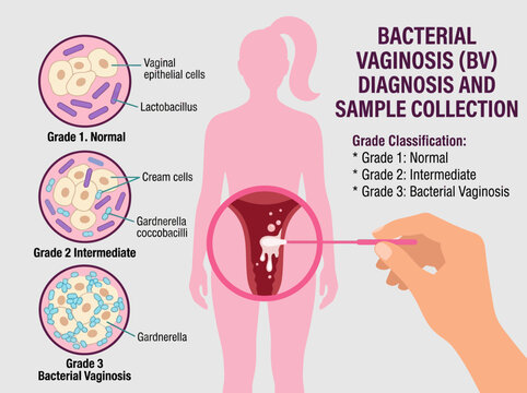 Bacterial Vaginosis (BV) Diagnosis and Sample Collection Medical Infographic with Microscopic Grade Classification
