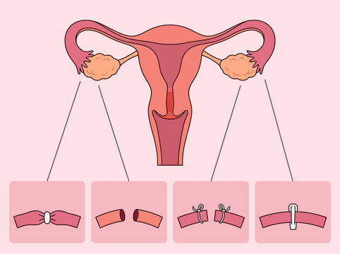 Medical Illustration of Female Sterilization Methods: Tubal Ligation Procedures including Banding, Cutting, Tying, and Clipping