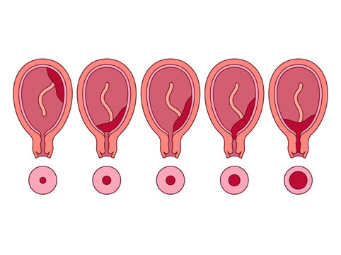 Medical Illustration of Placenta Previa Types: Normal, Low-Lying, Marginal, Partial, and Total Placental Positions in the Uterus