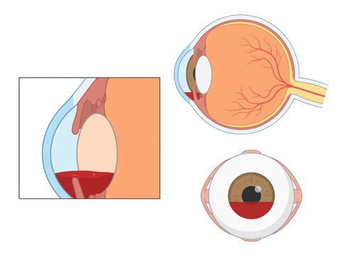 Medical Illustration of Hyphema - Blood in the Anterior Chamber of the Human Eye, Cross-Section and Front View Anatomy Diagram