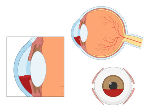 Medical Illustration of Hyphema Showing Blood Collection in the Anterior Chamber of the Eye