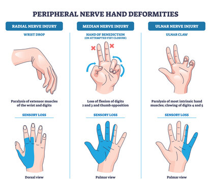 Peripheral nerve hand deformities diagram showing radial, median, and ulnar injuries with hands, nerve labels, and blue sensory loss shading for quick comparison. Outline diagram