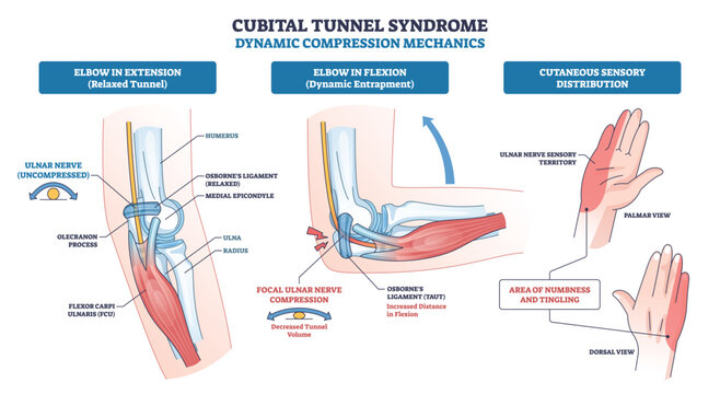 Cubital tunnel syndrome brief graphic shows ulnar nerve compression at the elbow in flexion vs extension and sensory areas, key objects, elbow joint, ulnar nerve, hand. Outline diagram