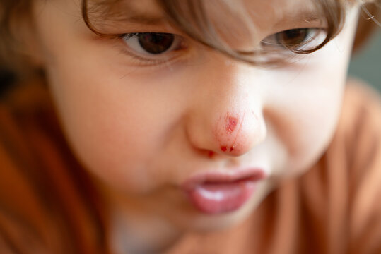 Closeup of a vulnerable toddler boy suffering from a bloody nose, showing pain and distress at home. This image highlights the need for safety and care for little one injuries.