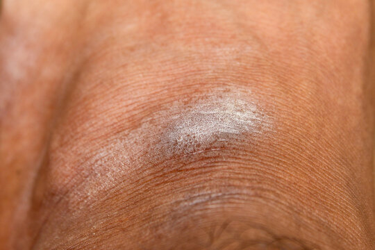 dry, scaly, and irritated skin on men's feet