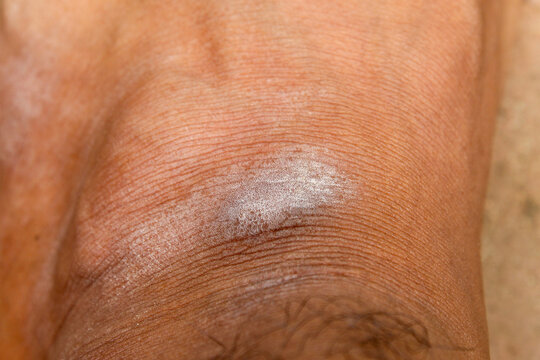 dry, scaly, and irritated skin on men's feet