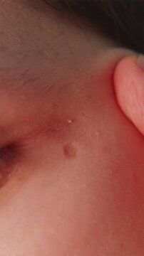 Man finger pointing at skin papilloma lesion on face