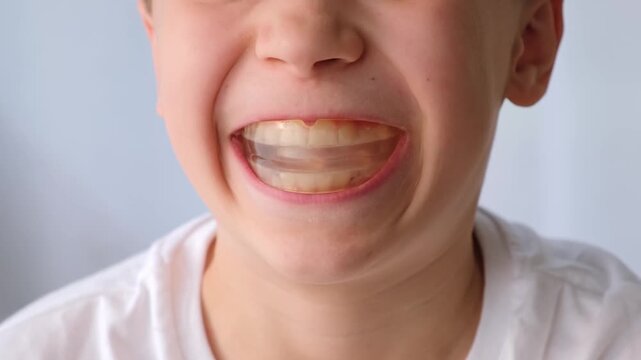 Portrait of ten year old caucasian boy smiling with a dental aligner in his mouth and looking at camera. Orthodontic treatment, dental care, oral hygiene. Teeth gap alignment or diastema. 4k Footage.