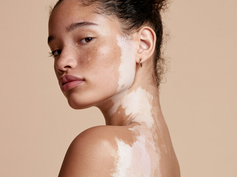 Confident woman with vitiligo portrait showing natural skin contrast and calm expression against beige background