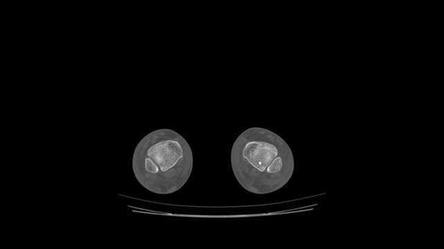 Axial Computed Tomography Scan of Bilateral Calcanei and Heel Bone Alignment