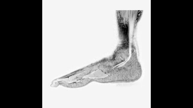 Sagittal View MRI Scan of Left Ankle and Foot Showing Bones Joints and Tendons