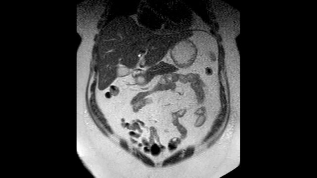 Abdominal MRI Scan with MRCP Sequence Showing Internal Organs Liver and Bile Ducts