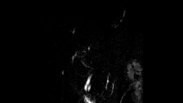 MRCP Magnetic Resonance Cholangiopancreatography Showing High Signal Biliary Tree and Pancreatic Duct