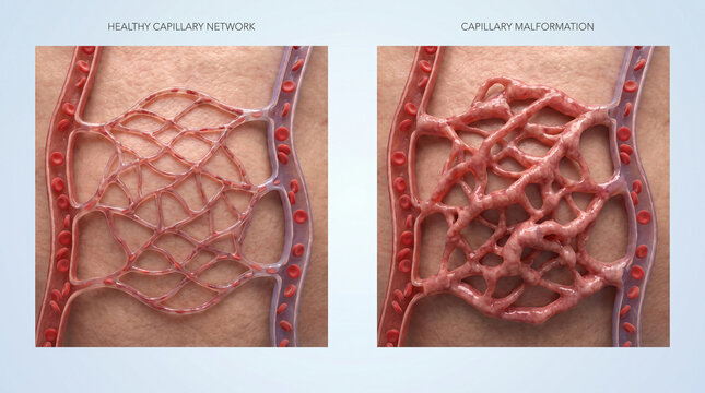 Capillary Malformation vs Healthy Capillary Network Anatomy
