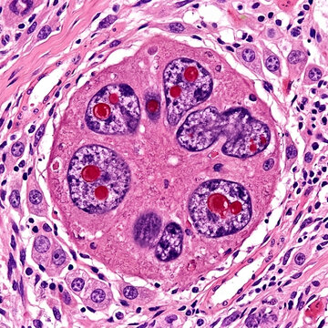 Microscopic View of Giant Cell Arteritis Lesion with Multinucleated Giant Cell and Inflammatory Infiltration