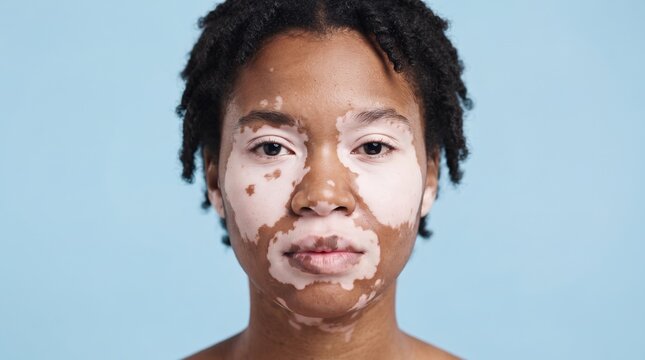 Frontal Portrait Of Young Black Woman Embracing Her Facial Vitiligo Depigmentation
