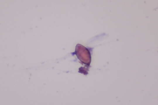 View in microscopic of Opisthorchis viverrini egg from human bile medical background concept. Egg parasite in stool exam real sample from patient liver cancer.