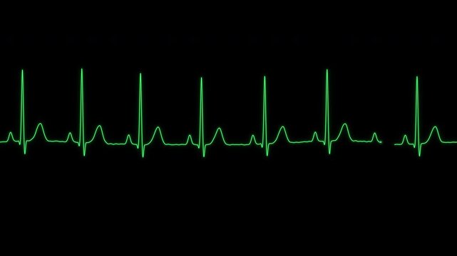 Normal sinus rhythm ECG sweep on a patient monitor seamless loop