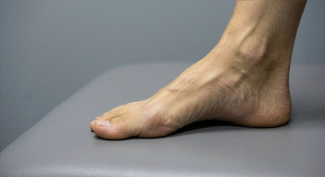 Close-up side view of a bare foot with flat arch on a grey examination table
