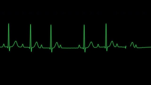 Wenckebach Mobitz type I second degree AV block ECG monitor loop