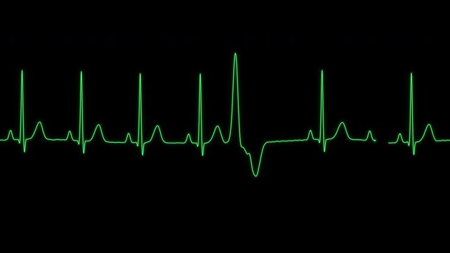 Sinus rhythm with premature ventricular contractions on ECG monitor