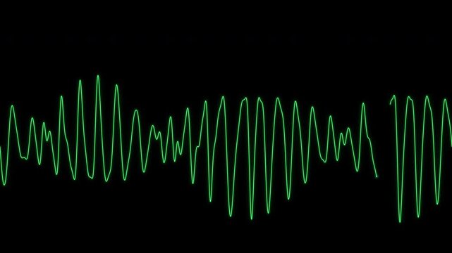 Torsades de pointes ECG polymorphic ventricular tachycardia loop