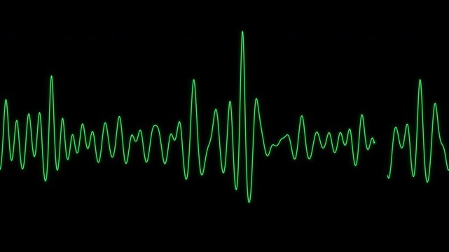 Ventricular fibrillation ECG on a heart monitor cardiac arrest loop