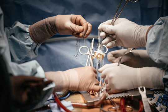 Cardiac surgeon implanting a bioprosthetic heart valve during open heart surgery, showing valve replacement, surgical instruments and cardiovascular surgery. Medical surgery concept and operating.