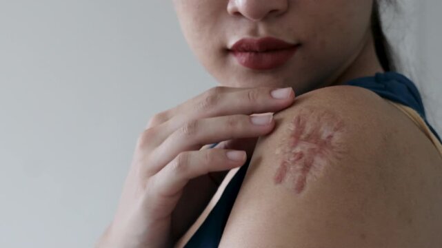 Close up of one 20s young adult Southeast Asian woman's left arm showing keloid scar from a vaccination